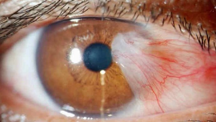 Птеригиум глаза: причины, симптомы, лечение, профилактика