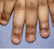 Птеригиум ногтей: причины, симптомы, лечение, профилактика