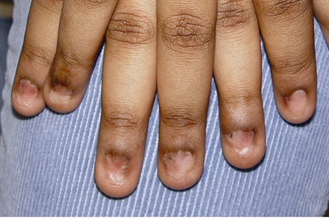Птеригиум ногтей: причины, симптомы, лечение, профилактика