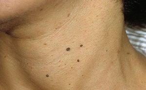 warts on neck