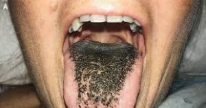 black hairy tongue