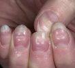 Причины появления волнистых ногтей – лечение и профилактика