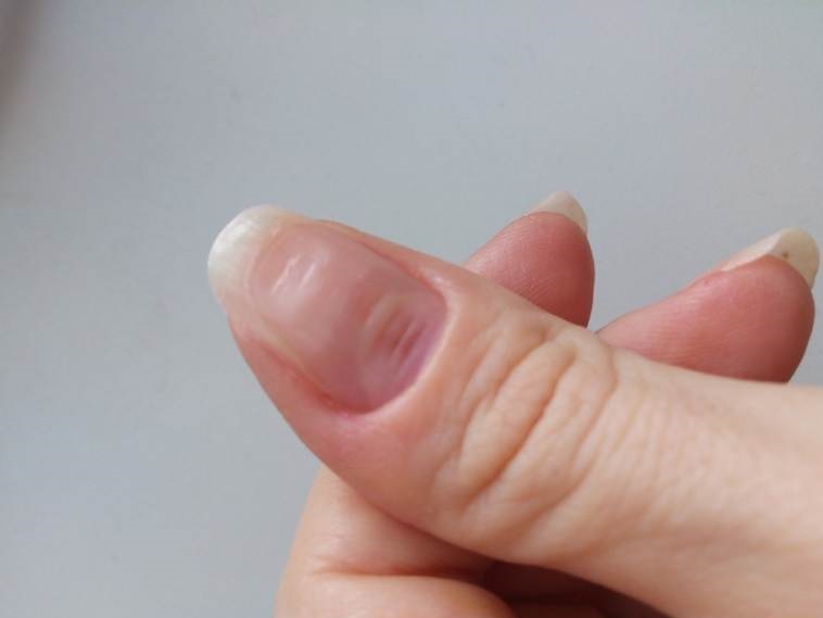 Симптомы волнистых ногтей – типы, причины и методы лечения