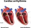 8 типов аритмии сердца, которые необходимо наблюдать