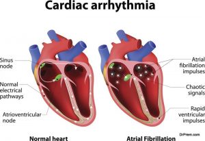 cardiac arrythmia