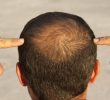 13 причин выпадения волос