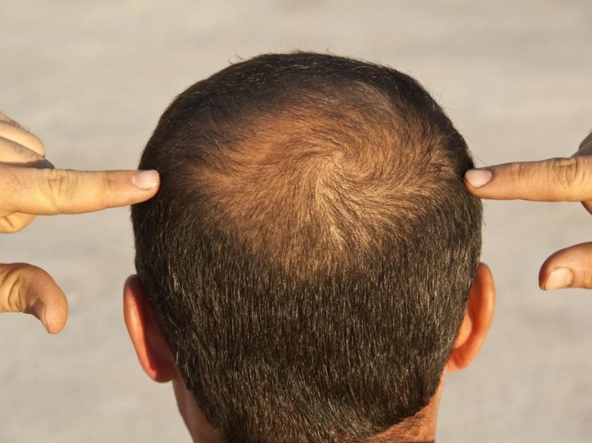 13 причин выпадения волос