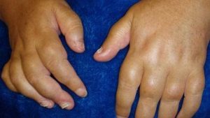swelling fingers