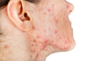 acne before period