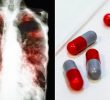 14 способов избавиться от побочных эффектов лечения туберкулеза