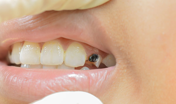 Что может вызвать черное разрушение зуба? Как это можно предотвратить?