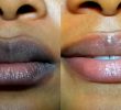 Причины темной пигментации на губах и как от нее избавиться